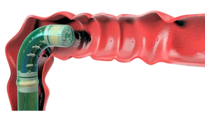 InchIGRAB: An Inchworm-Inspired Guided Retraction and Bending Device for Vine Robots During Colonoscopy featured image